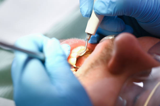 Best Emergency Dental Care for Broken or Chipped Teeth in Ller, WA